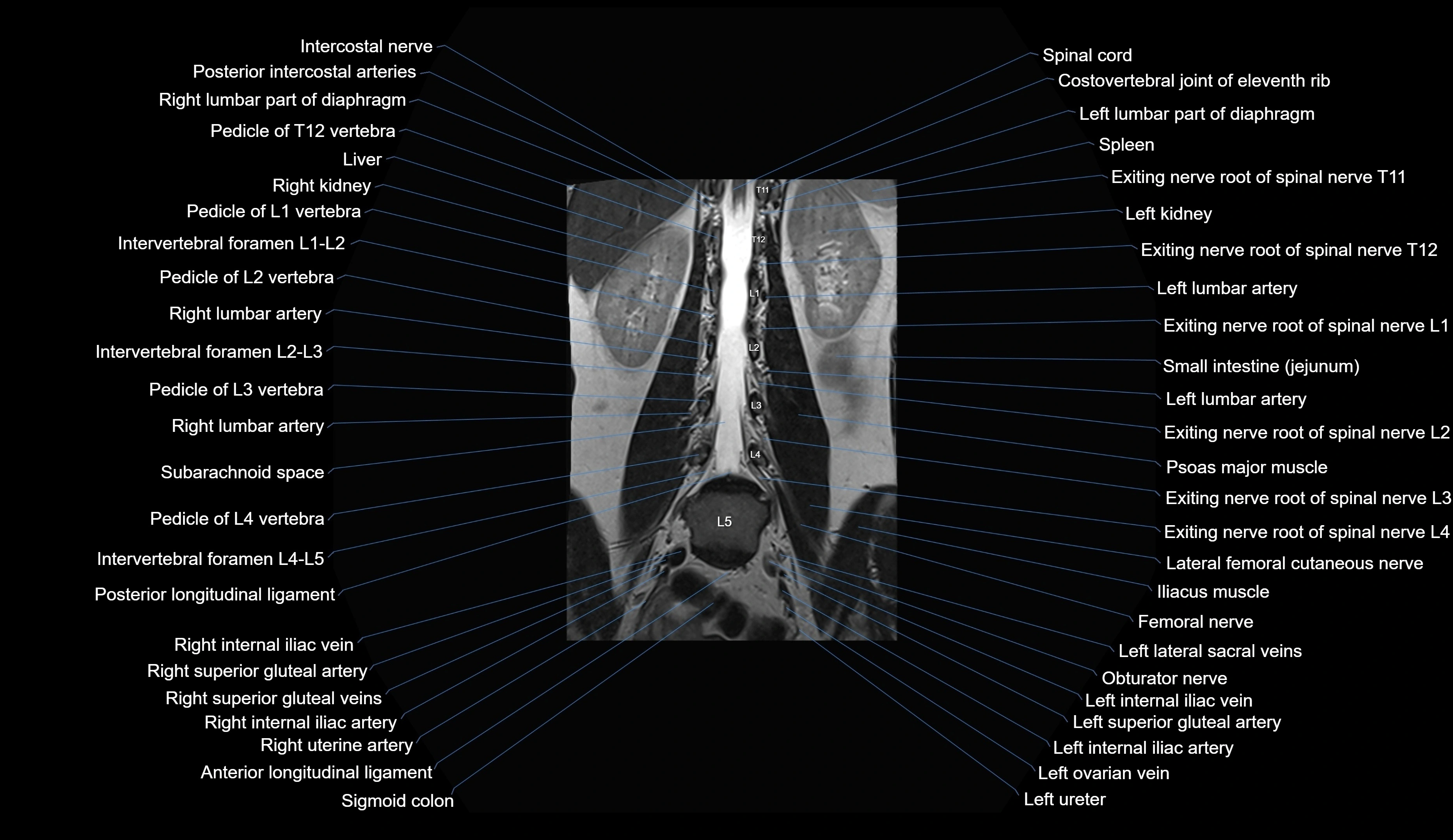 MRI lumbar spine coronal cross sectional anatomy 3T radiology  image-img-00001-00017.webp